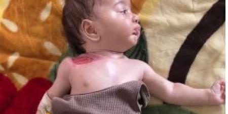 تلوث المياه بغزة يسبب التهابات نادرة لرضيعة عمرها 3 شهور تضعف مناعتها - الكويت الاخباري