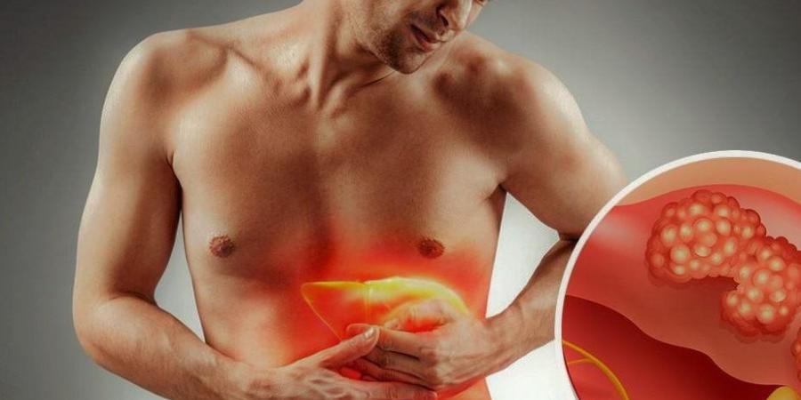 يسبب التليف.. أعراض الكبد الدهني وأهم أسبابه - الكويت الاخباري