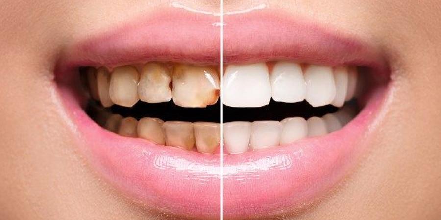 اصفرار الأسنان.. الأسباب والحلول - الكويت الاخباري