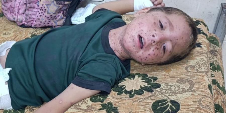 الطفح الجلدي ينهش أجساد الغزيين وصيدليات خاوية من كل دواء - الكويت الاخباري